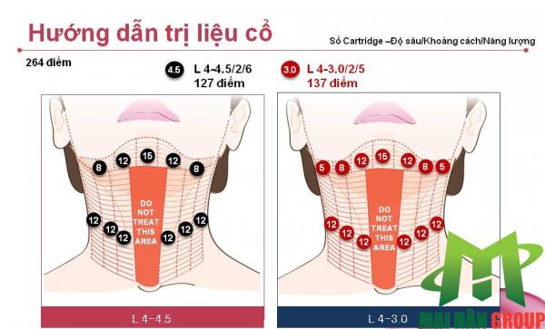 Hướng dẫn trị liệu cho vùng cổ