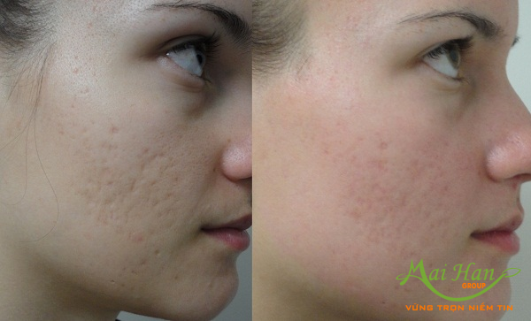 Điều trị sẹo lõm bằng Fractinal Co2 Laser mang lại làn da đẹp hơn trông thấy Điều trị sẹo lõm bằng Fractinal Co2 Laser mang lại làn da đẹp hơn trông thấy