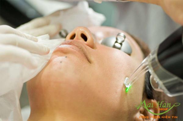 Ba giải pháp trị sẹo rỗ từ thiên nhiên hiệu quả: công nghệ Fractional Laser CO2