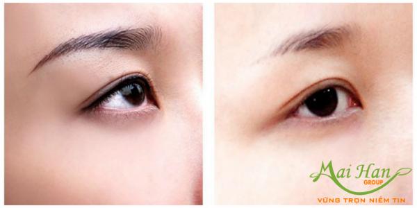 Sai lầm thường gặp khi xóa xăm là gì? Sai lầm thường gặp khi xóa xăm là gì?