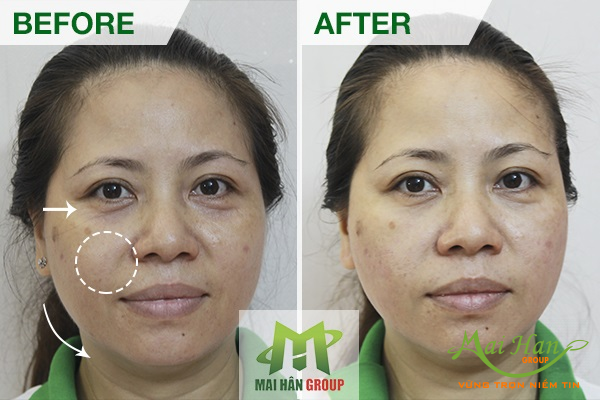 Mai Hân Group tiếp nhận công nghệ spa HIFU - RF - VACUUM số 1 Hàn Quốc Mai Hân Group tiếp nhận công nghệ spa HIFU - RF - VACUUM số 1 Hàn Quốc