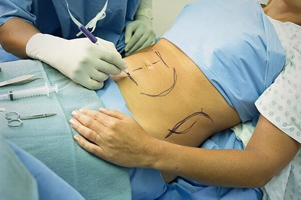 Những kỹ thuật hút mỡ nào thực sự an toàn và ít đau: công nghệ RF