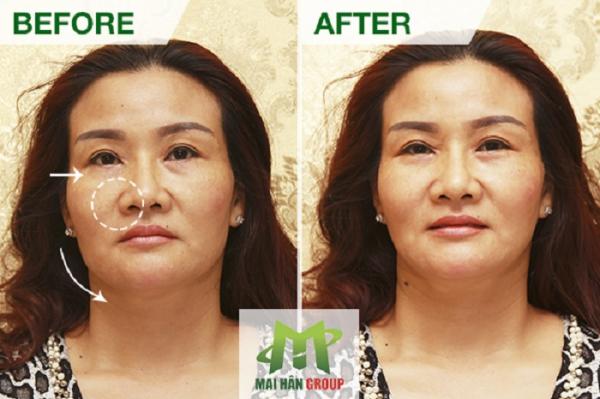 Mai Hân Group tiếp nhận công nghệ spa HIFU - RF - VACUUM số 1 Hàn Quốc Mai Hân Group tiếp nhận công nghệ spa HIFU - RF - VACUUM số 1 Hàn Quốc