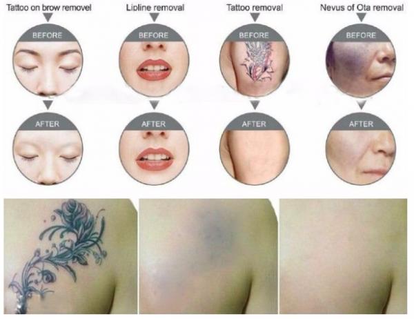 SỞ HỮU NGAY MÁY XÓA XĂM CÔNG NGHỆ HÀNG ĐẦU HOA KỲ SỞ HỮU NGAY MÁY XÓA XĂM CÔNG NGHỆ HÀNG ĐẦU HOA KỲ