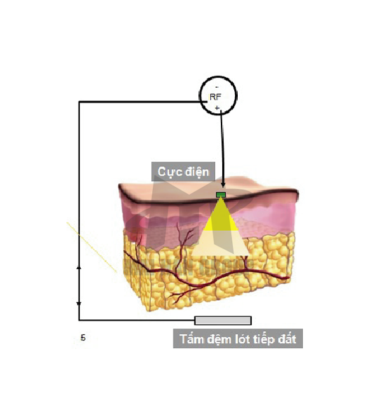 Một số hình ảnh công nghệ RF tác động lên da