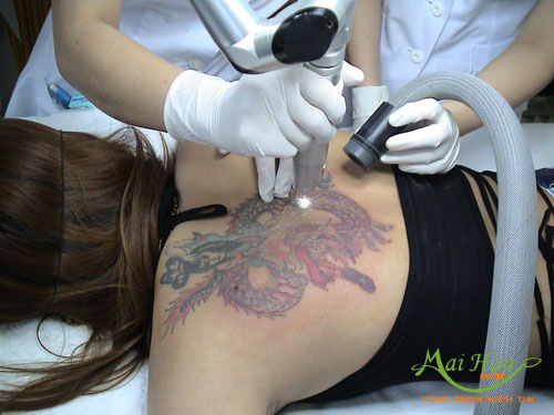 Xóa xăm bằng laser Xóa xăm bằng laser