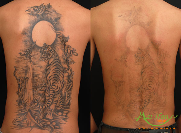 Xóa xăm hiệu quả Xóa xăm hiệu quả